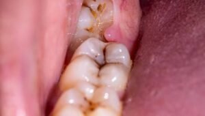 Wisdom Tooth Removal: What Patients Should Know Before Scheduling